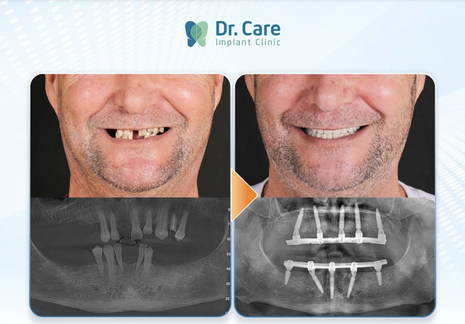 Kết quả điều trị thực tế tại Dr. Care