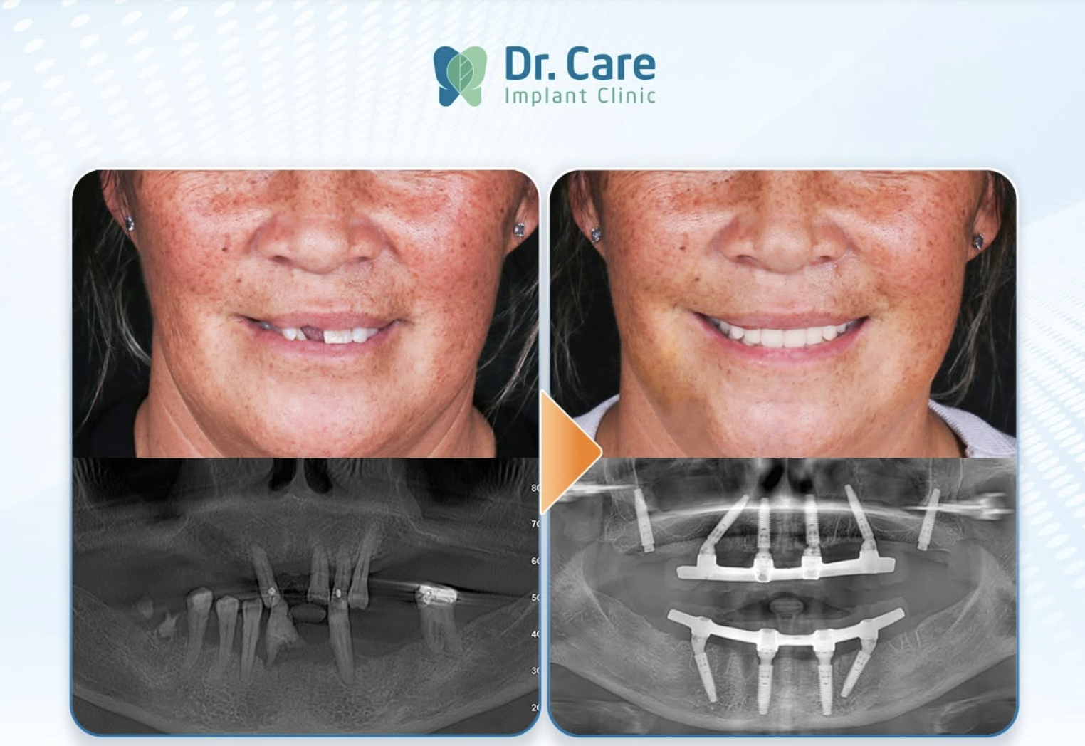 Kết quả điều trị thực tế tại Dr. Care
