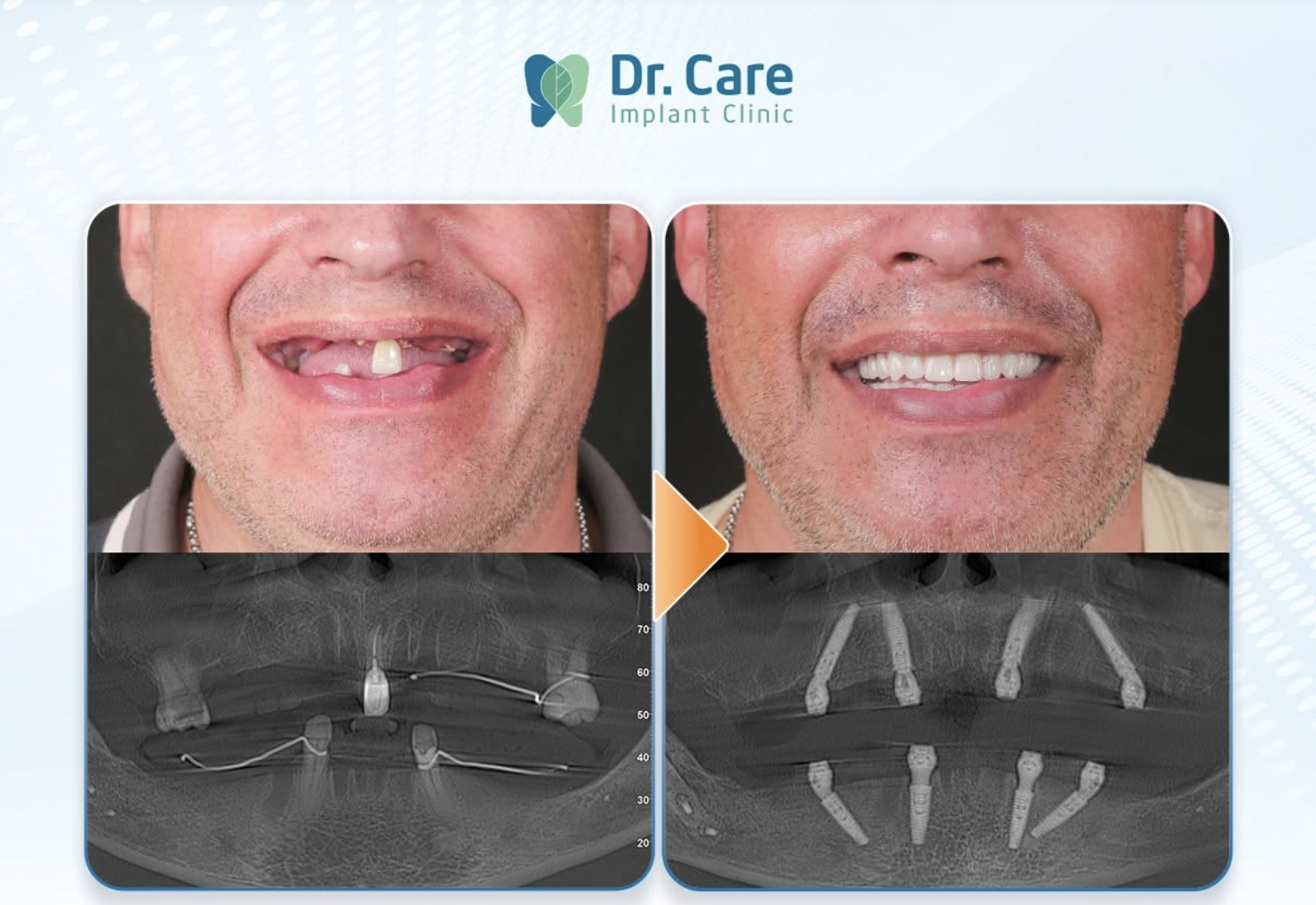Kết quả điều trị thực tế tại Dr. Care