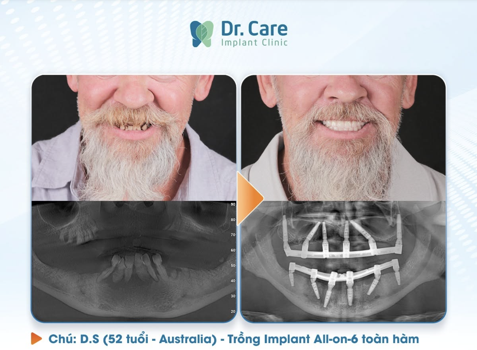 Kết quả điều trị thực tế tại Dr. Care