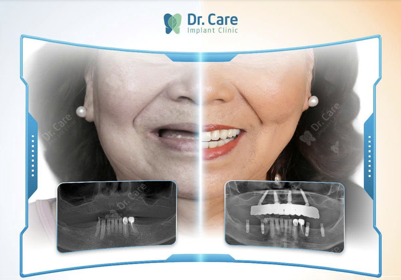Kết quả điều trị thực tế tại Dr. Care