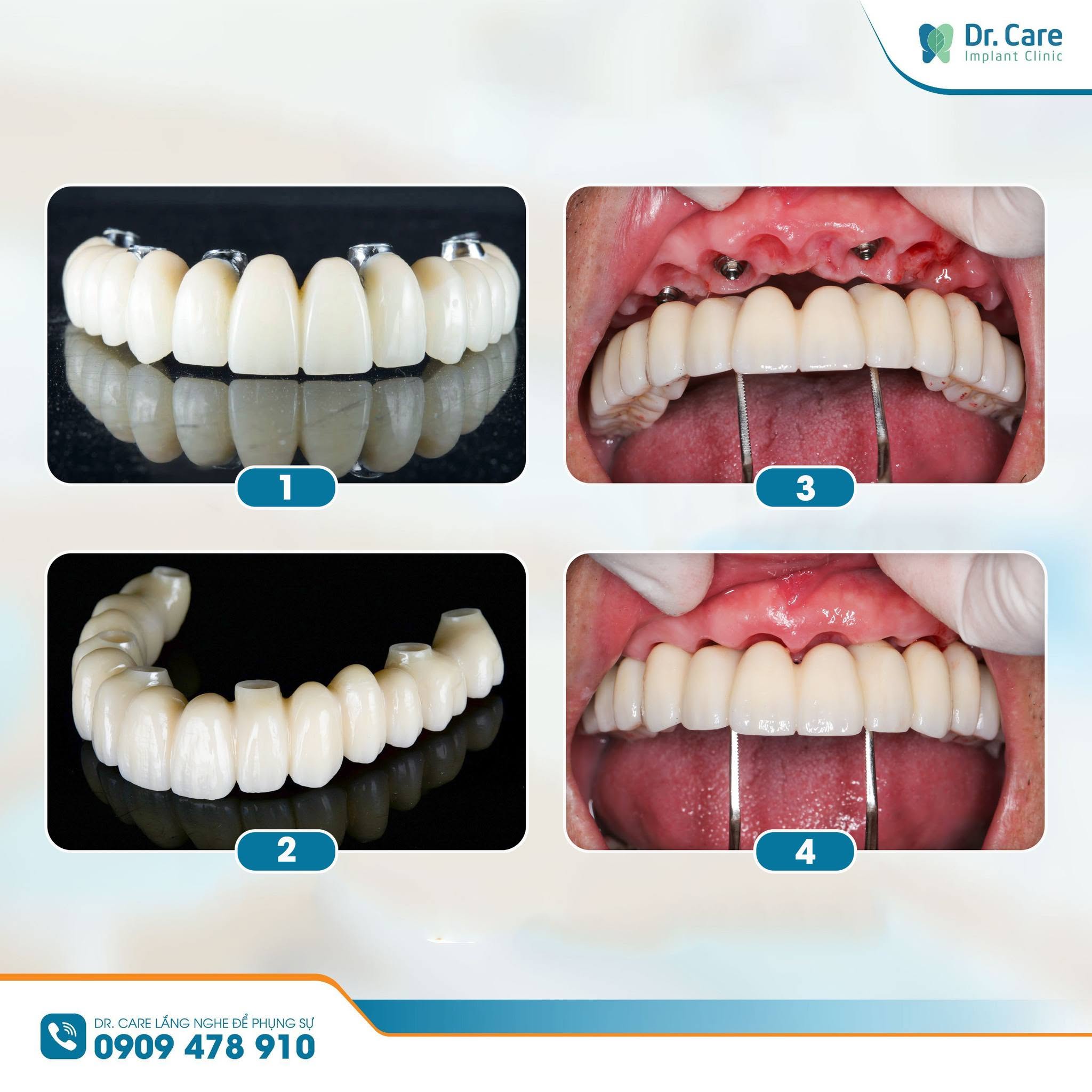 Gắn hàm cố định trên implant
